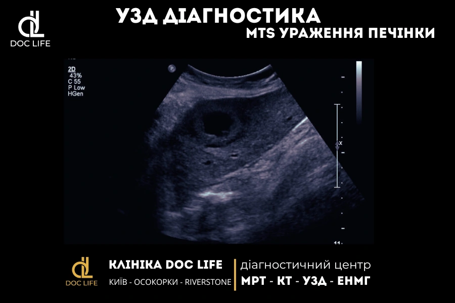 Гіпоехогенні Метастази В Печінці На Узд

