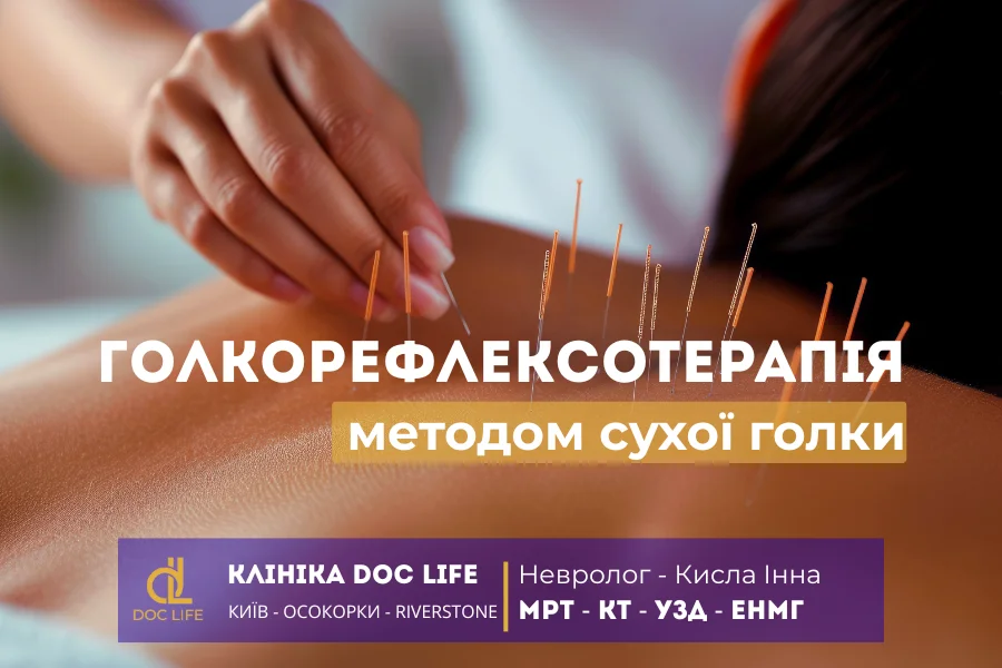 Голкорефлексотерапія Методом Сухої Голки