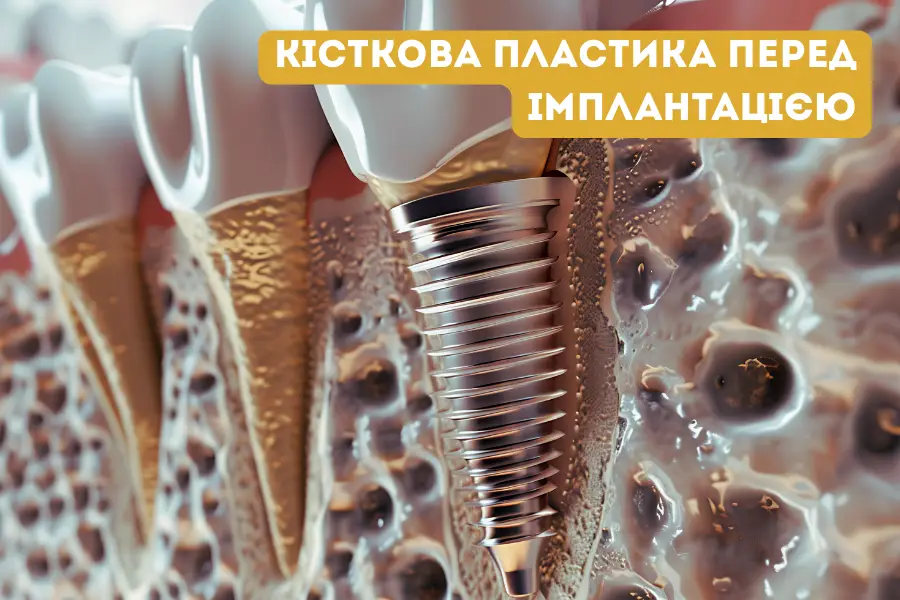 Кісткова Пластика Перед Імплантацією 1