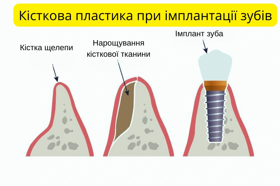 Кісткова Пластика Перед Імплантацією