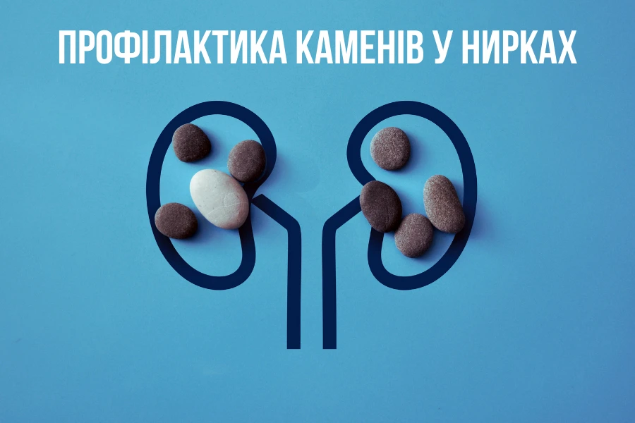 Профілактика Каменів У Нирках: Що Радять Лікарі