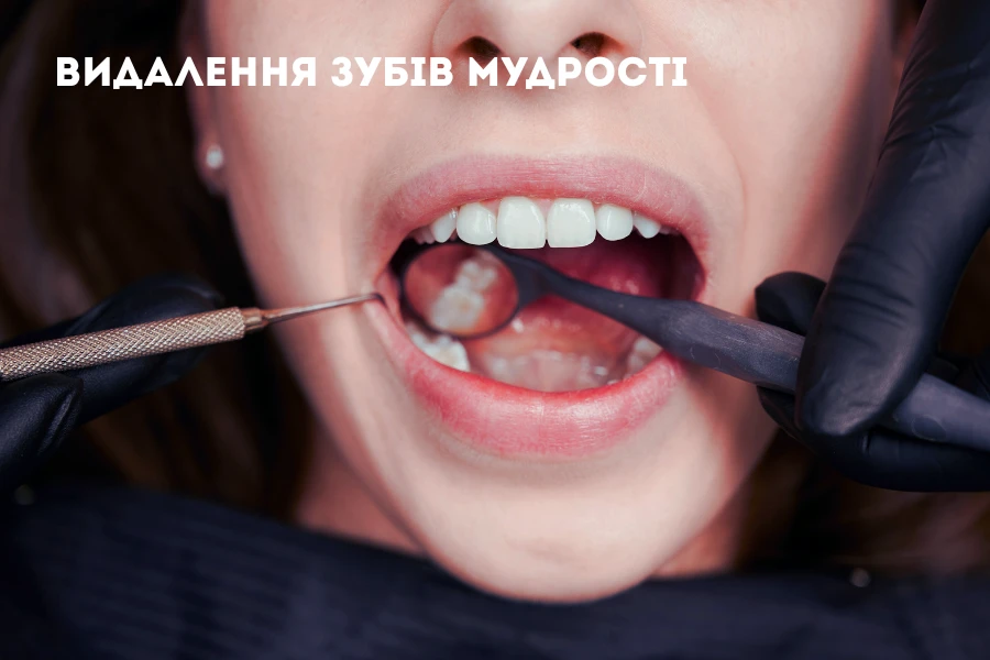 Видалення Зубів Мудрості 4
