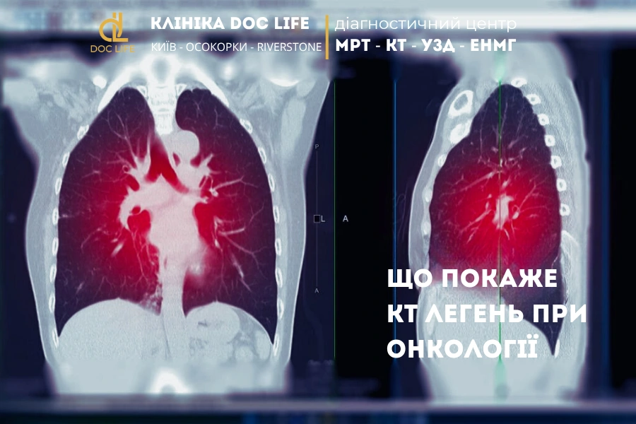 Що Покаже Кт Легень При Онкології