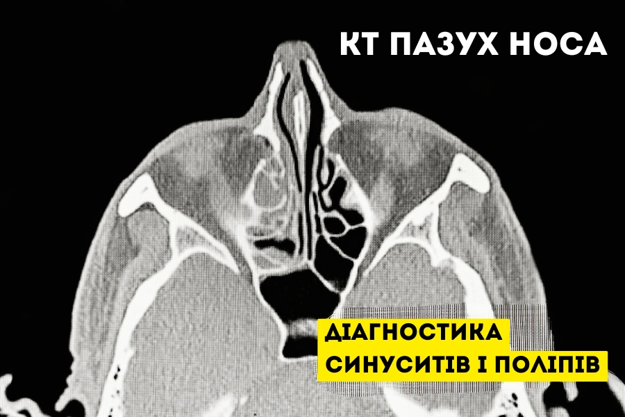Кт Пазух Носа: Точна Діагностика Синуситів І Поліпів