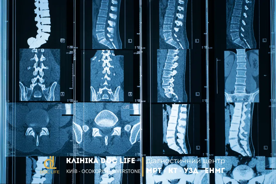 Які Захворювання Може Виявити Кт Хребта При Болю У Спині