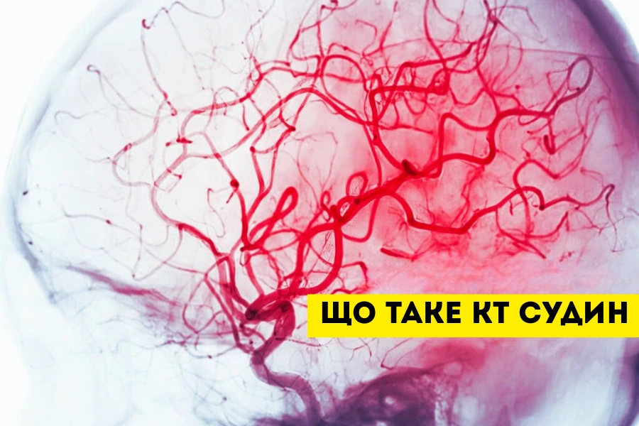 Кт Судин: Сучасна Альтернатива Ангіографії