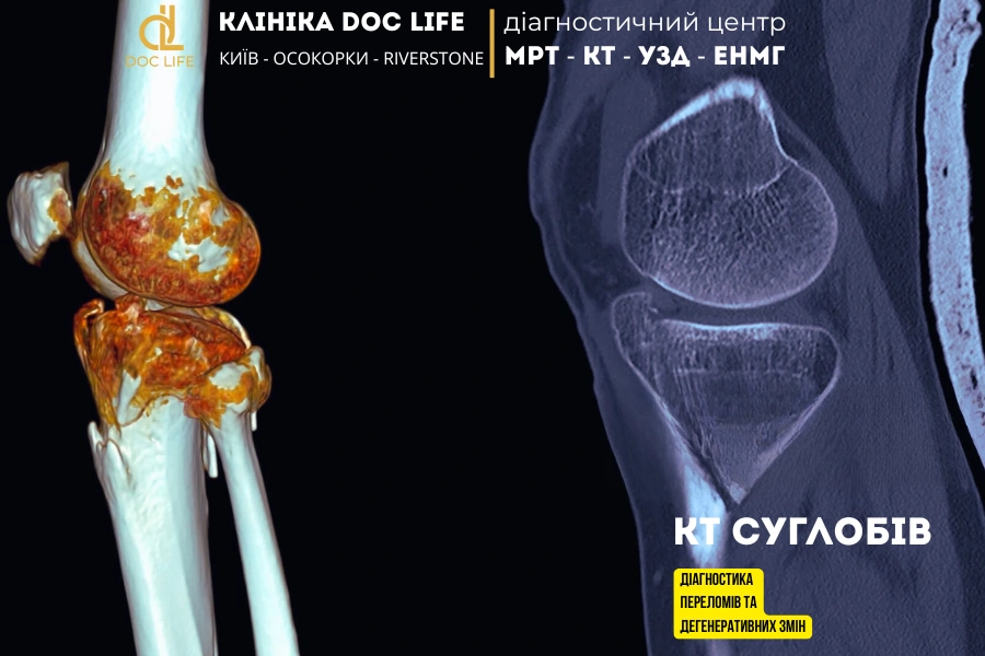 Кт Суглобів: Діагностика Переломів Та Дегенеративних Змін