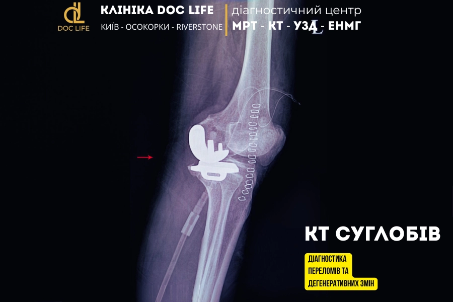 Kt Suglobiv Diagnostyka Perelomiv Ta Degeneratyvnyh Zmin 3