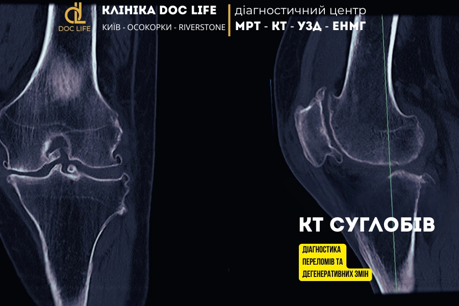 Kt Suglobiv Diagnostyka Perelomiv Ta Degeneratyvnyh Zmin 4