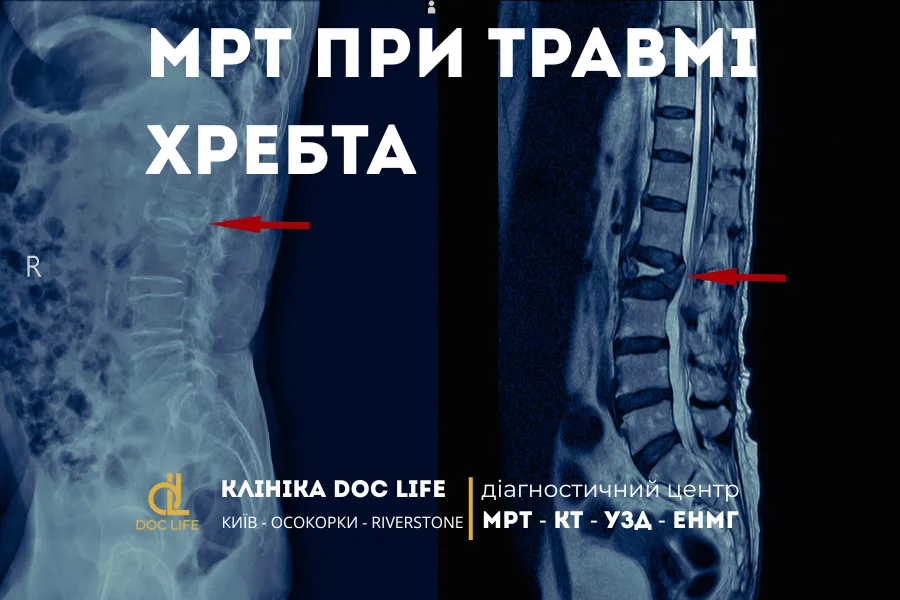 Мрт При Травмі Хребта: Чому Важлива Точна Діагностика?