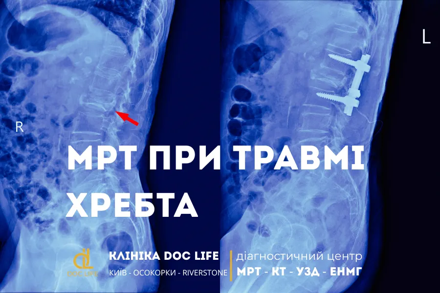 Коли Потрібно Робити Мрт При Травмі Хребта