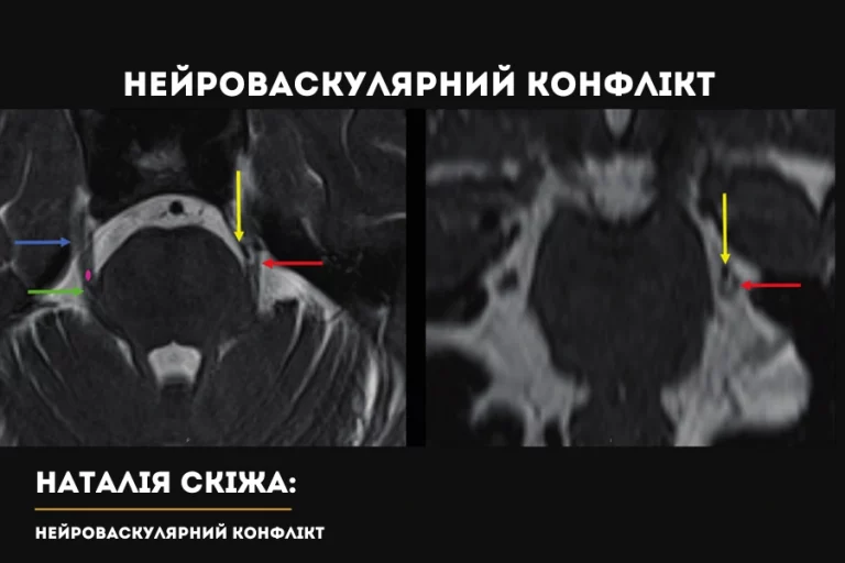 Нейроваскулярний Конфлікт Київ Скіжа Наталія 1