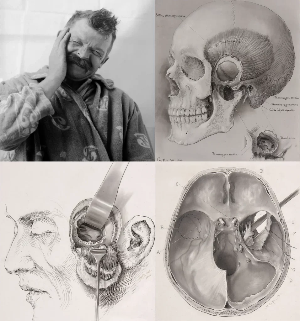 Фото Із Сайту Нейрохірурга Наталія Скіжа - Https://Neurohirurg-Kyiv.com/Head-Brain/Nejrovaskulyarnyj-Konflikt/  Нейроваскулярний Конфлікт Діагностика Мрт Та Лікування У Києві