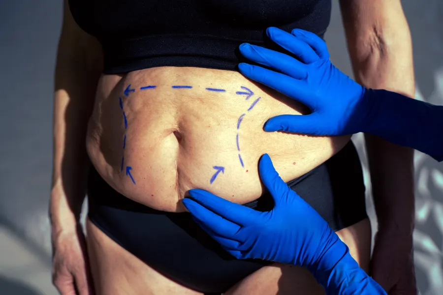 Види Пластики Живота: Індивідуальний Підхід