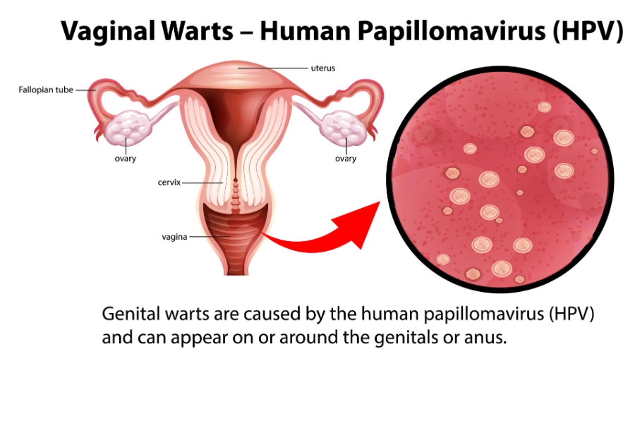 Вульвовагініт: коли симптоми не можна ігнорувати 13 Vulvovaginit 6