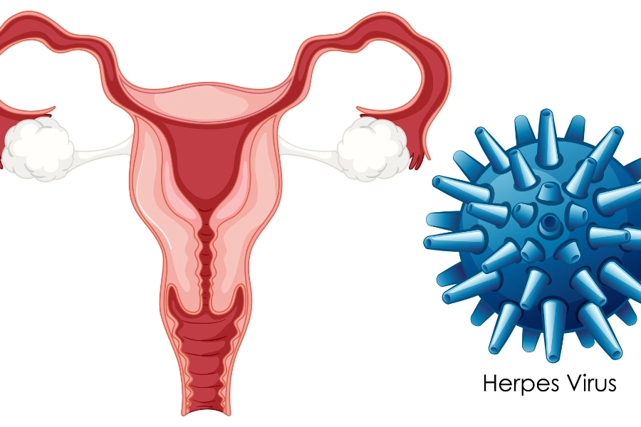 Вульвовагініт: коли симптоми не можна ігнорувати 14 Vulvovaginit 7
